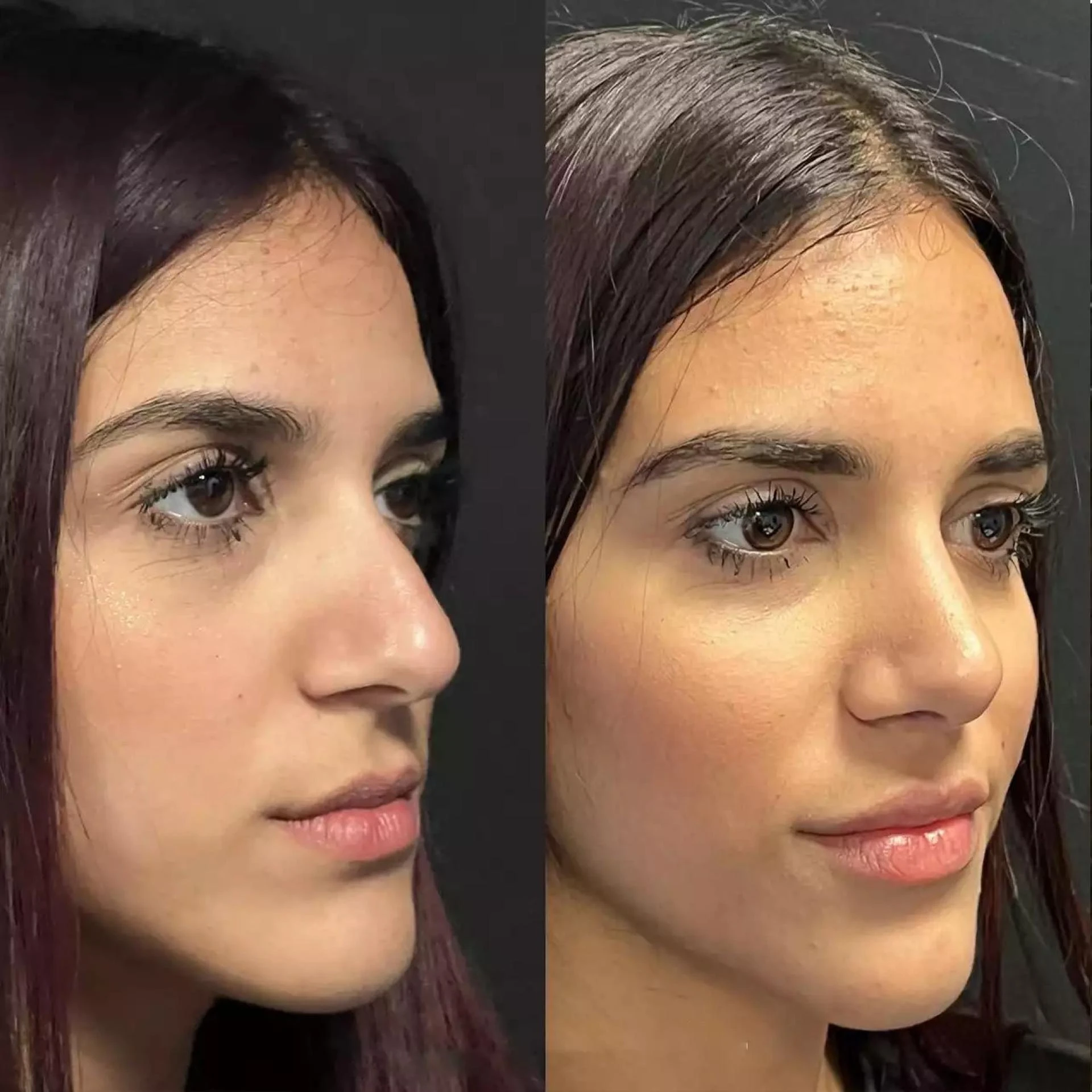 Best Septoplasty Surgeon in Dubai: Certified and Trusted