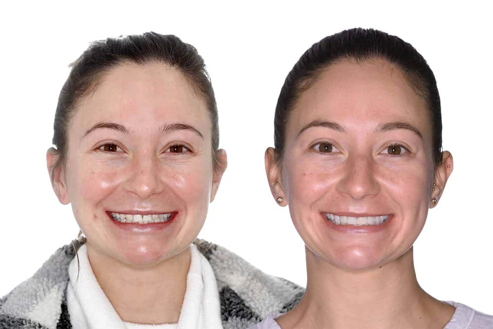 Porcelain Veneers in Brisbane: The Premium Choice for a Perfect Smile