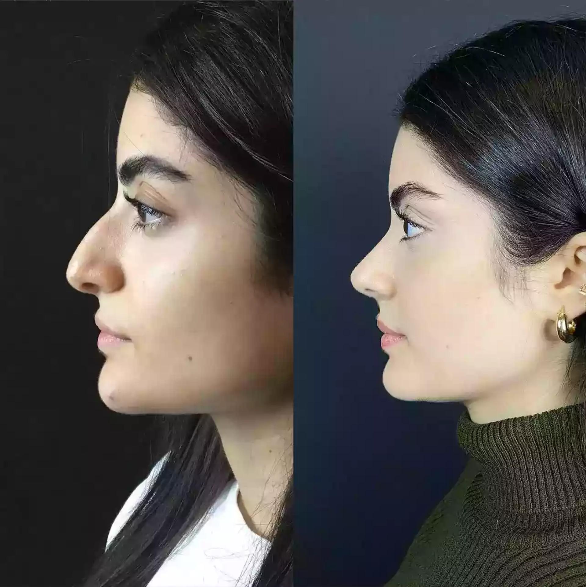 Septoplasty in Dubai for Deviated Septum: What You Should Know