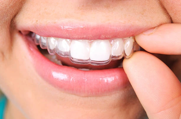 How Invisalign Works: Step-by-Step Breakdown of the Treatment Process