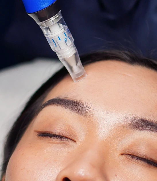 What Happens to Your Skin After SkinPen Microneedling?
