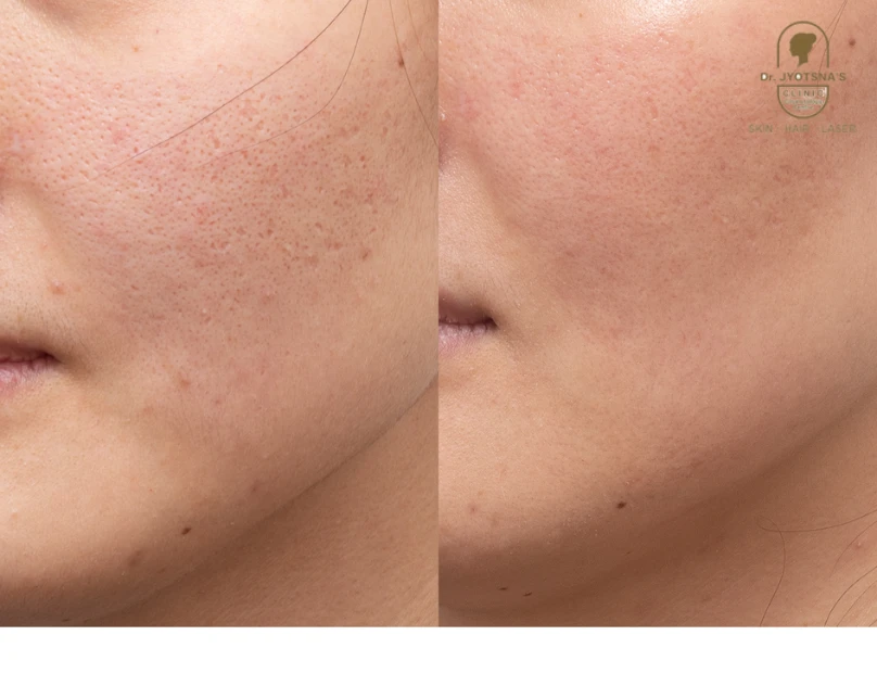 Rediscover Smoother Skin with Fractional RF Skin Resurfacing Treatment in Thane Gentle Technology That Talks to Your Skin