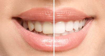 Achieve Your Dream Smile: Cosmetic Dentistry Services in Adelaide