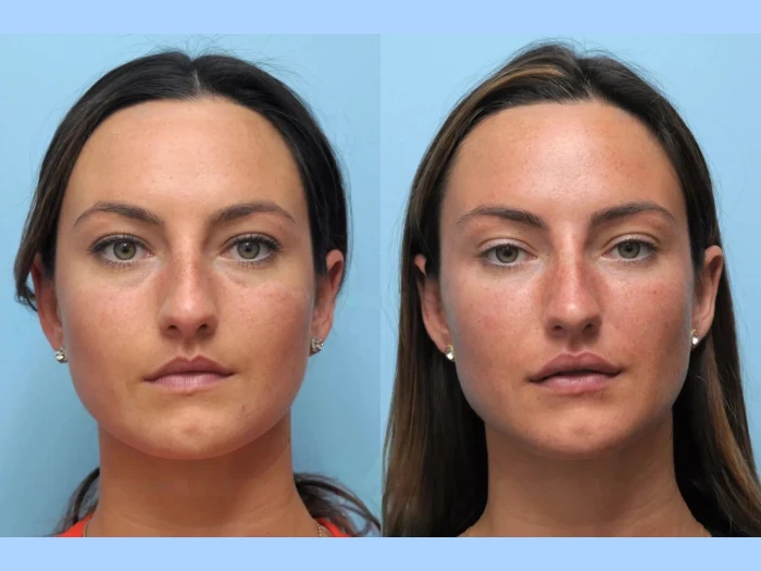 Why Thread Lift in Dubai Is the New Face of Anti-Aging Treatments