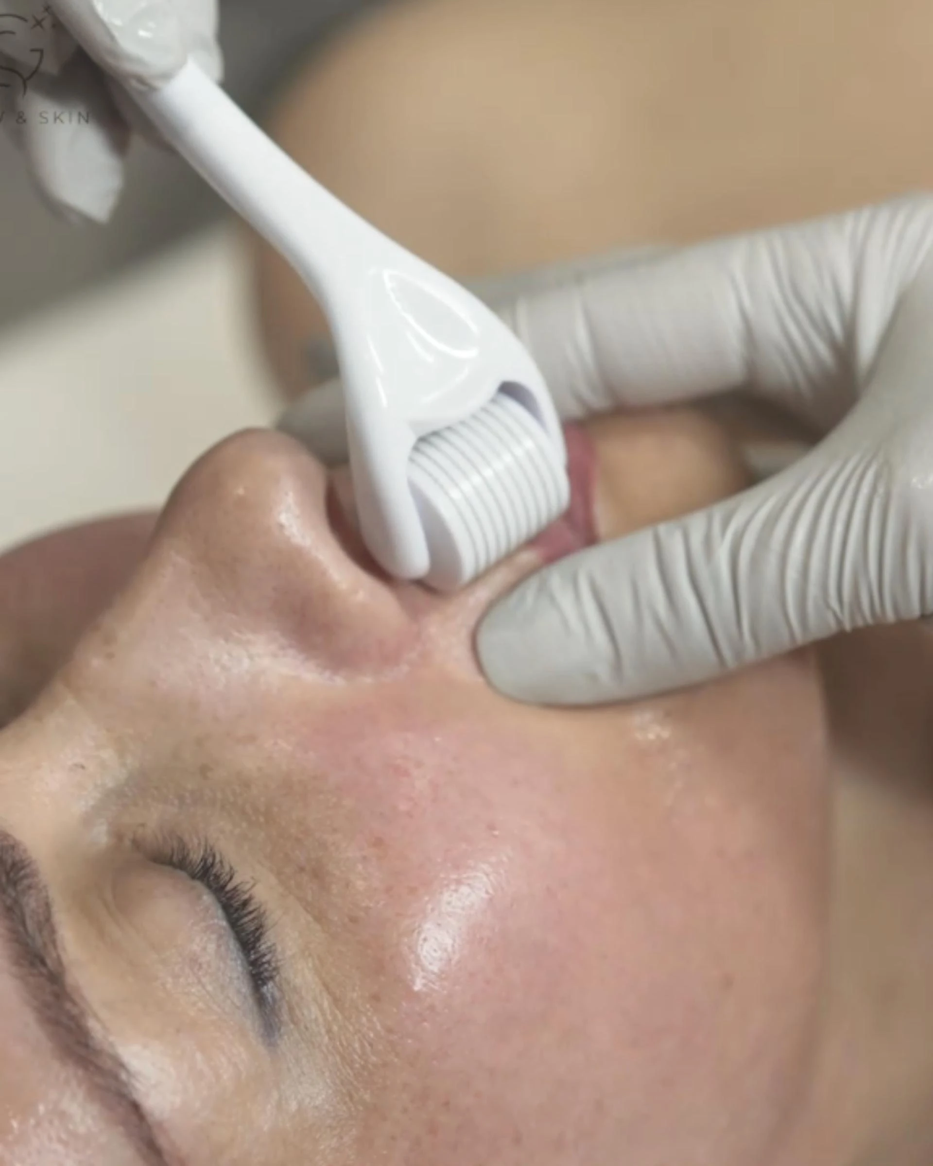 A Professional’s Guide to Choosing the Right Microneedling Kit