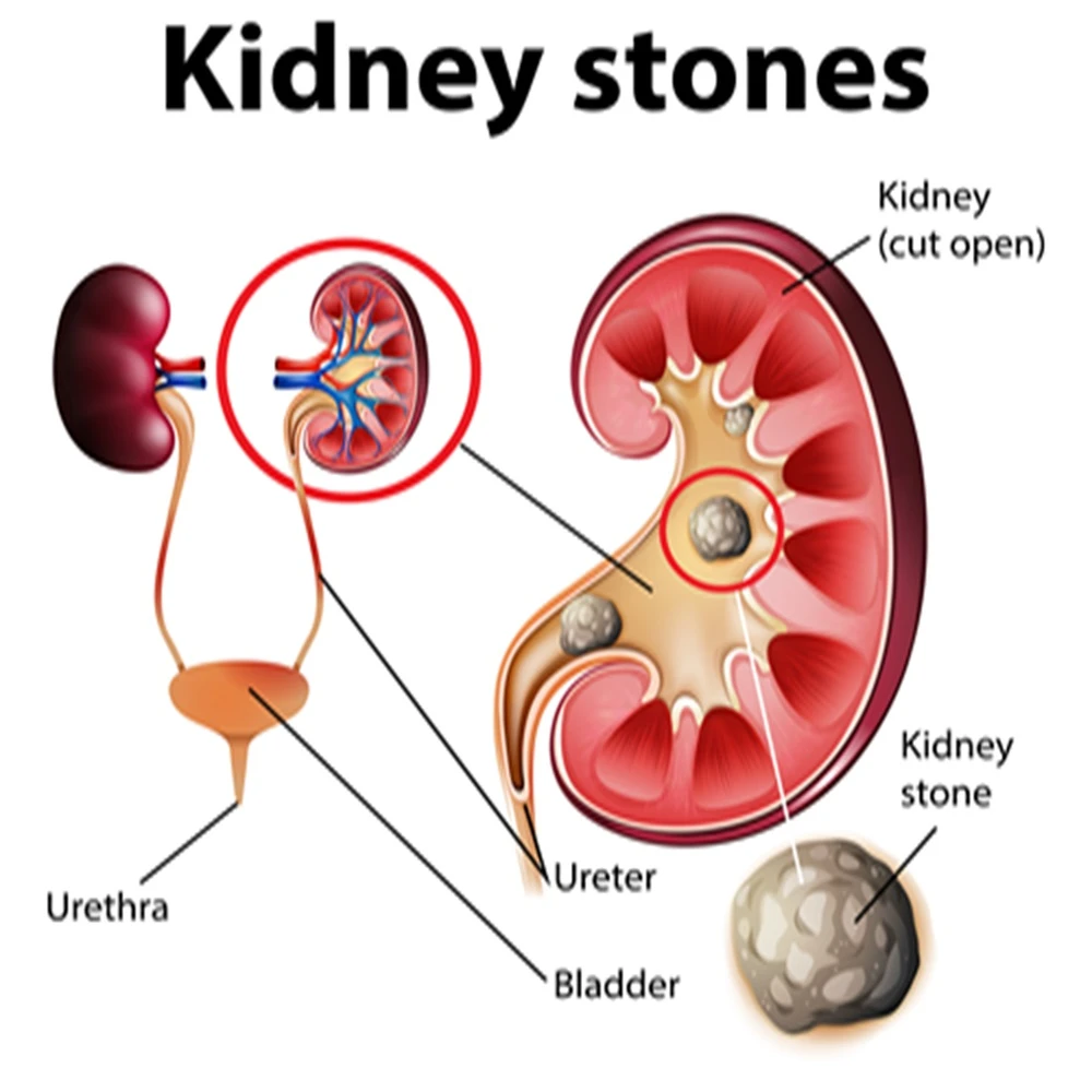 How Are Kidney Stones Formed