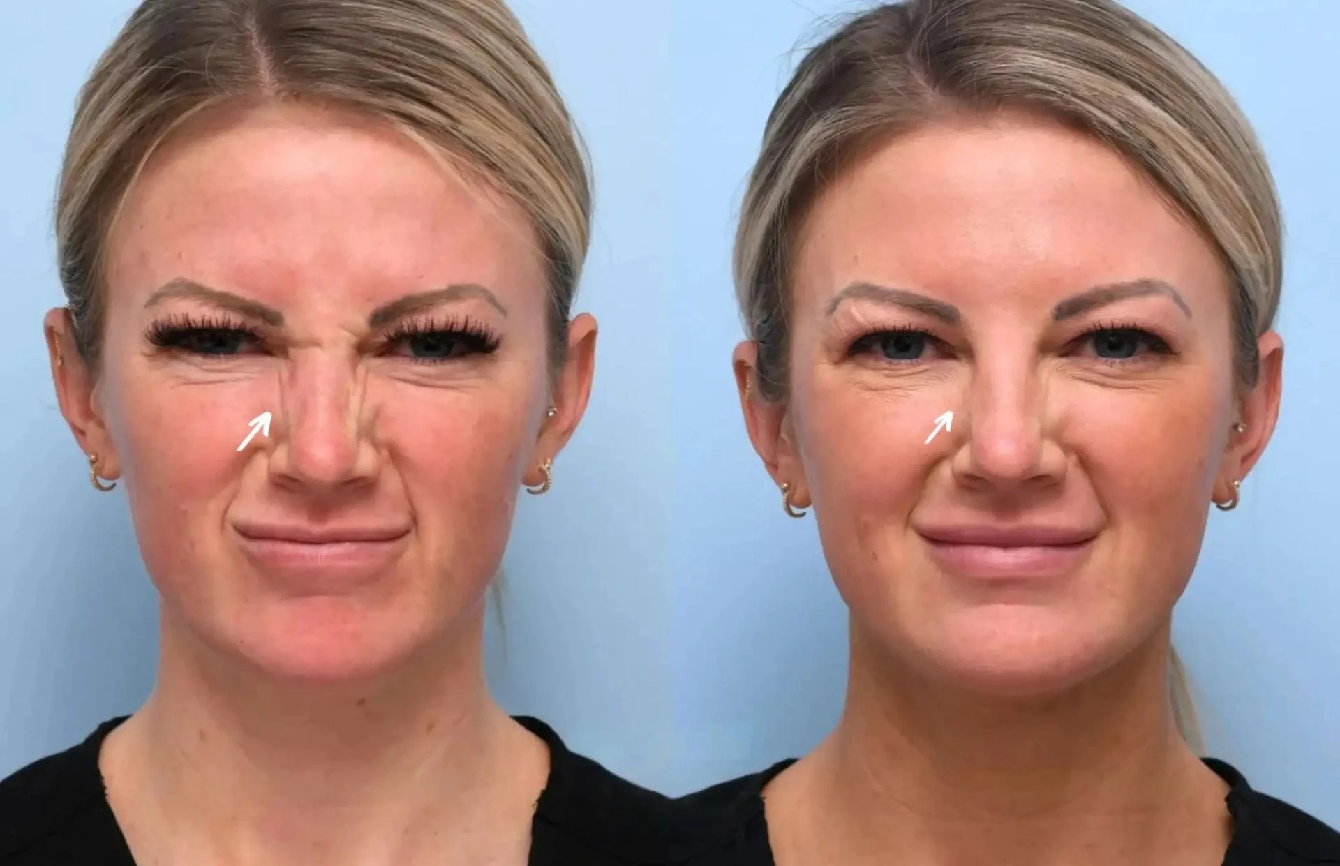 Botox Treatments in Dubai How to Prepare for Your Appointment