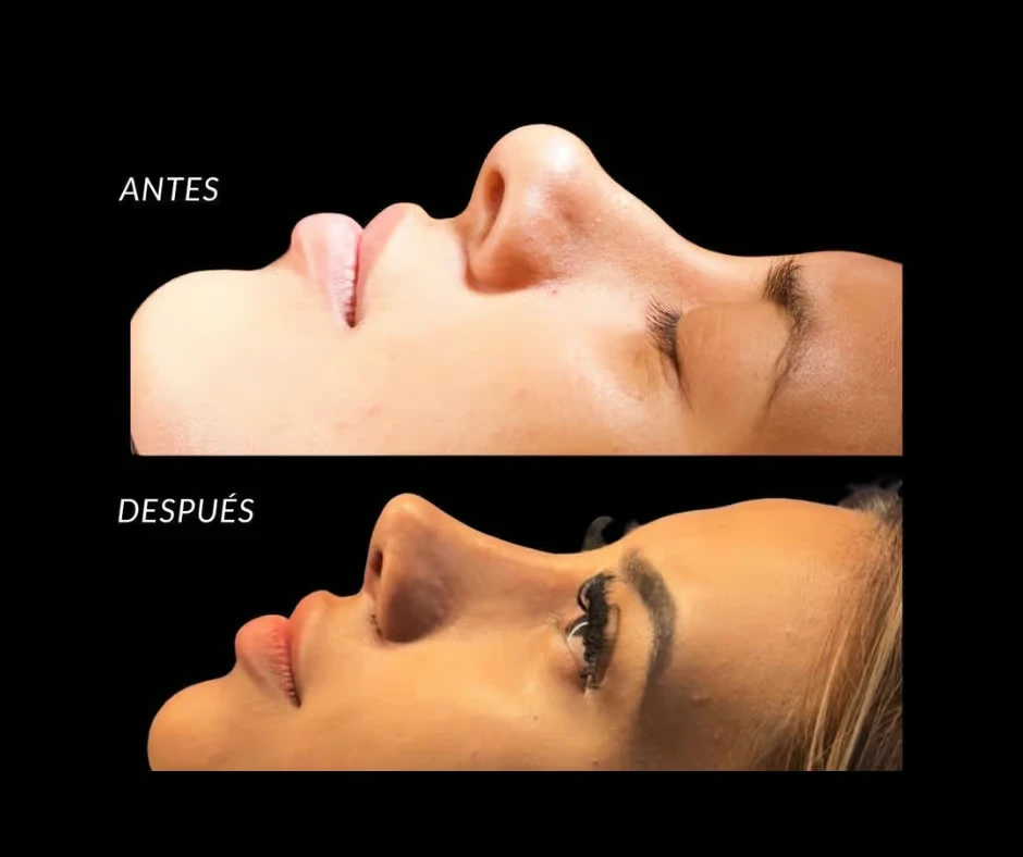 Técnica RPD y injertos fascio musculares: una nueva visión en cirugía nasal avanzada