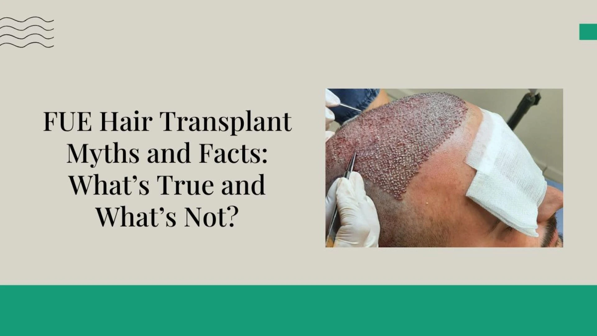 FUE Hair Transplant Myths and Facts: What’s True and What’s Not?