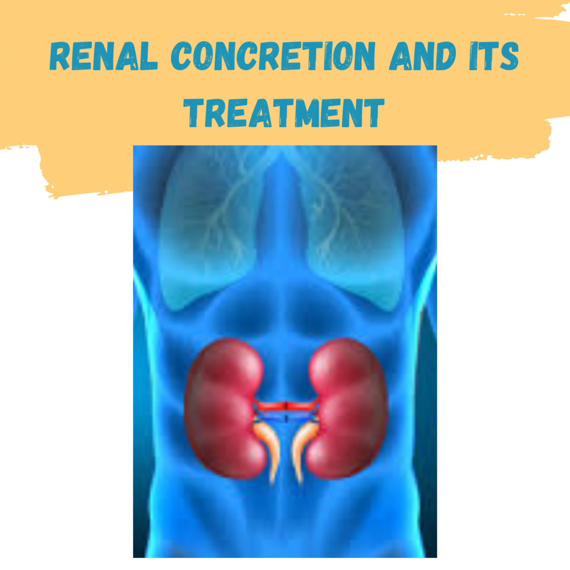 Renal concretion and its treatment | Best Kidney hospital in Delhi