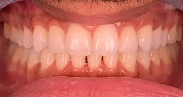 What Is The Role Of An Invisalign Dentist In Improving Your Smile?