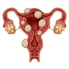 Draft: My Post Uterine Fibroid Treatment Market Fueled by Expanding Healthcare Access and Reimbursement in Emerging EconomiesTitle