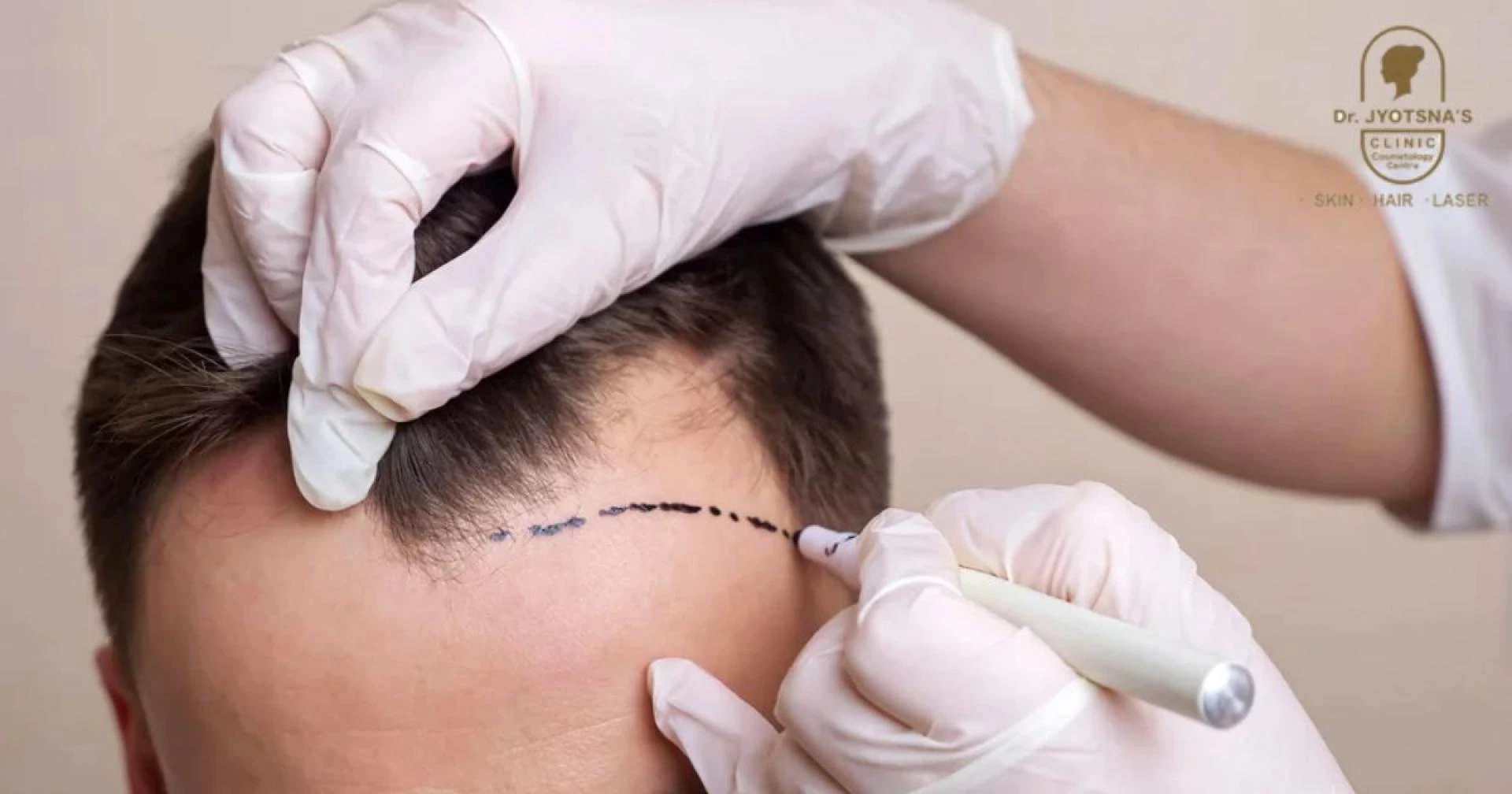 Regain Your Confidence: The Ultimate Guide to Hair Transplant in Thane