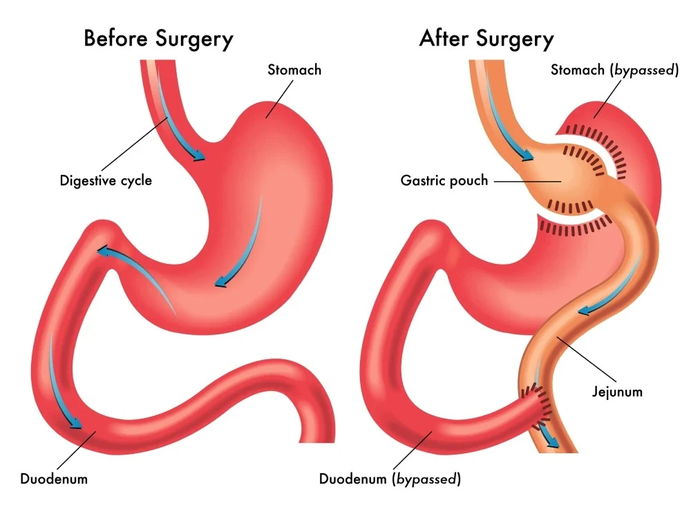 What You Need to Know About Gastric Bypass, Gallbladder & Robotic Surgery in the Bayou City