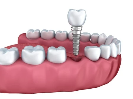Understanding Implant Teeth Cost: A Comprehensive Guide by Utama Dental