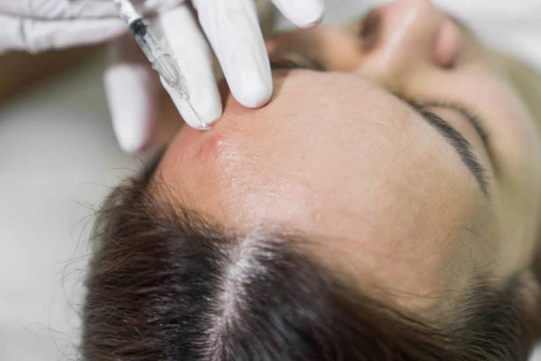 The Step-by-Step PRP Hair Treatment Experience Unveiled