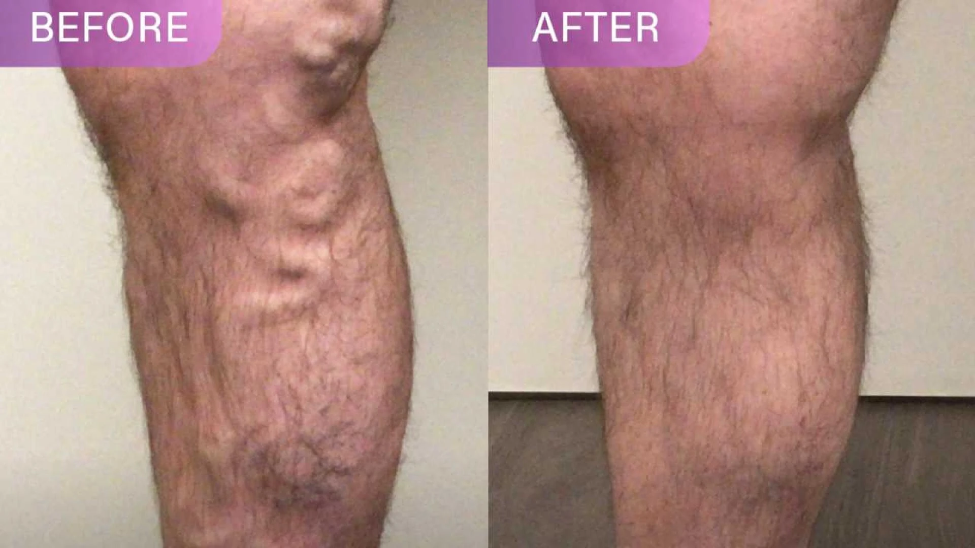 How Can I Find The Best Clinic For Chronic Venous Insufficiency In New York?