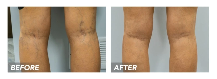 Who Is the Top Spider Vein Doctor in NYC for Minimally Invasive Treatments?