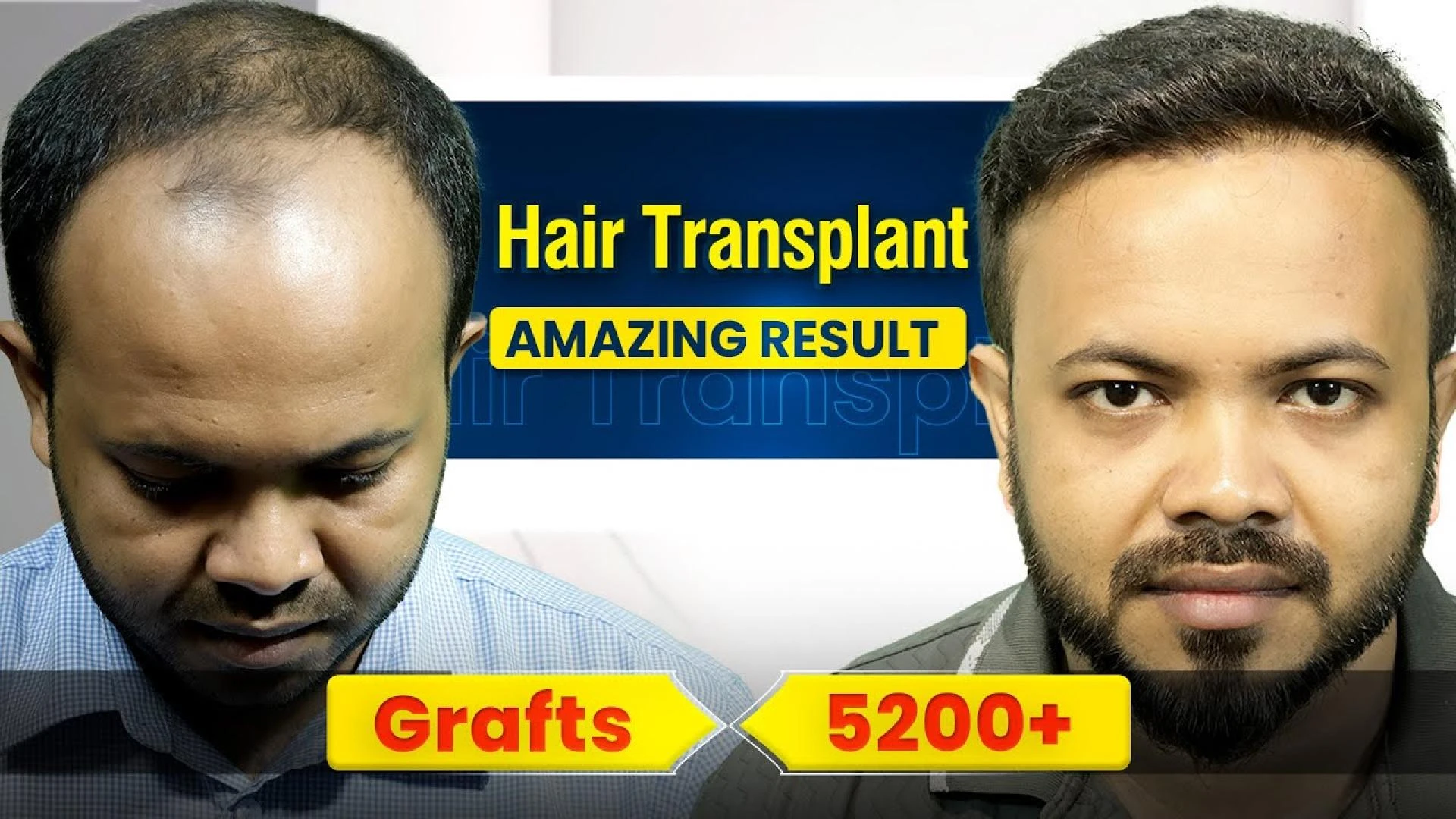 Review of Mehadi Hasan | Hair Transplant Journey in Bangladesh