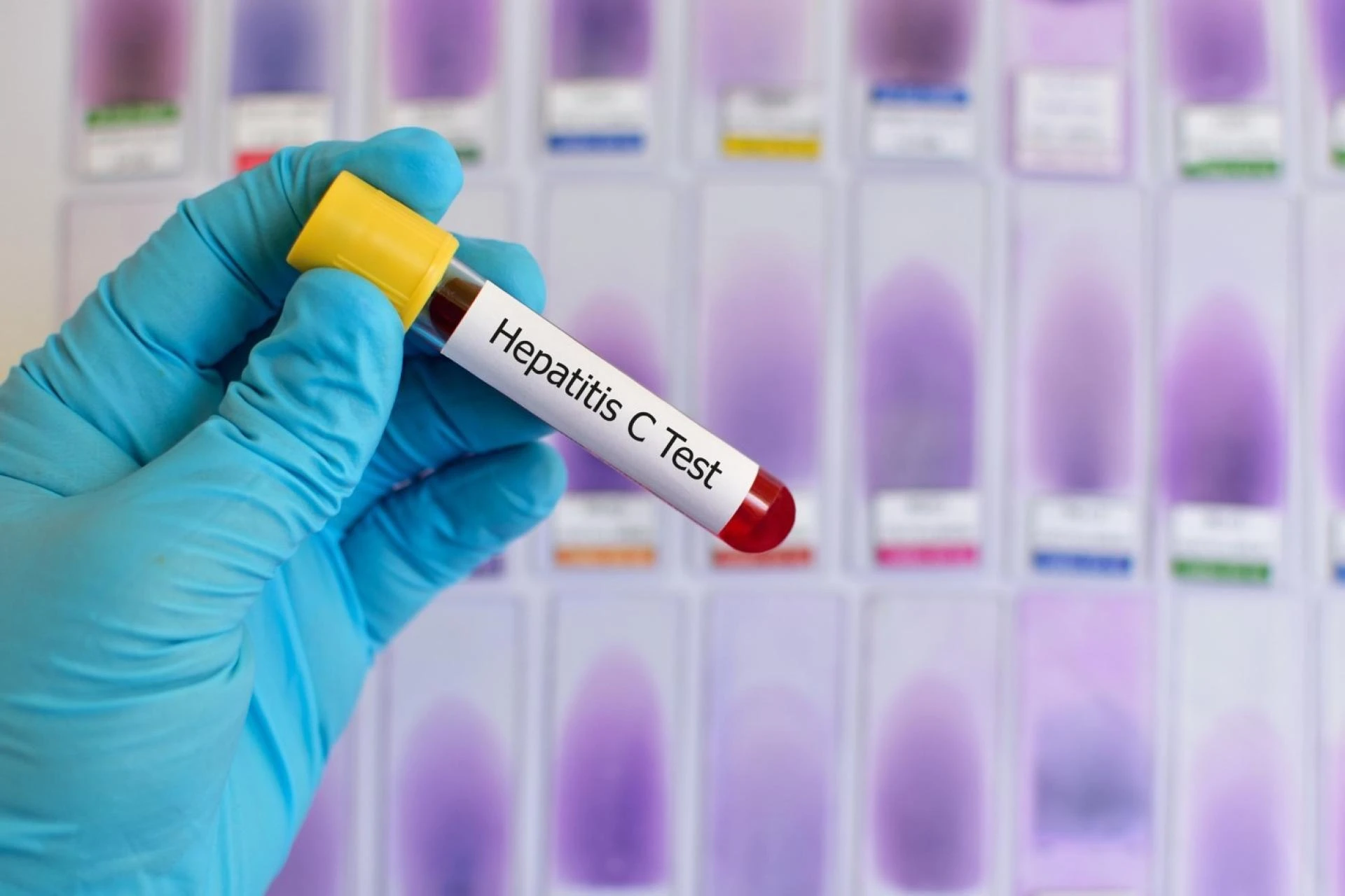 Living with Hepatitis C: Diet and Lifestyle Guidelines 