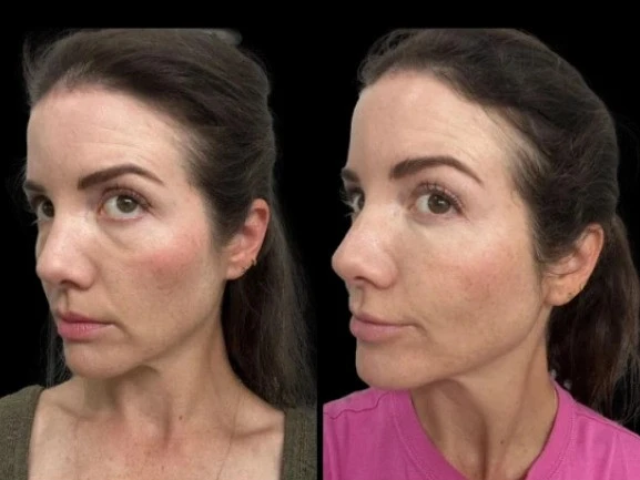The Role of Technology in Dark Circles Treatment at the Best Aesthetic Clinic in Dubai