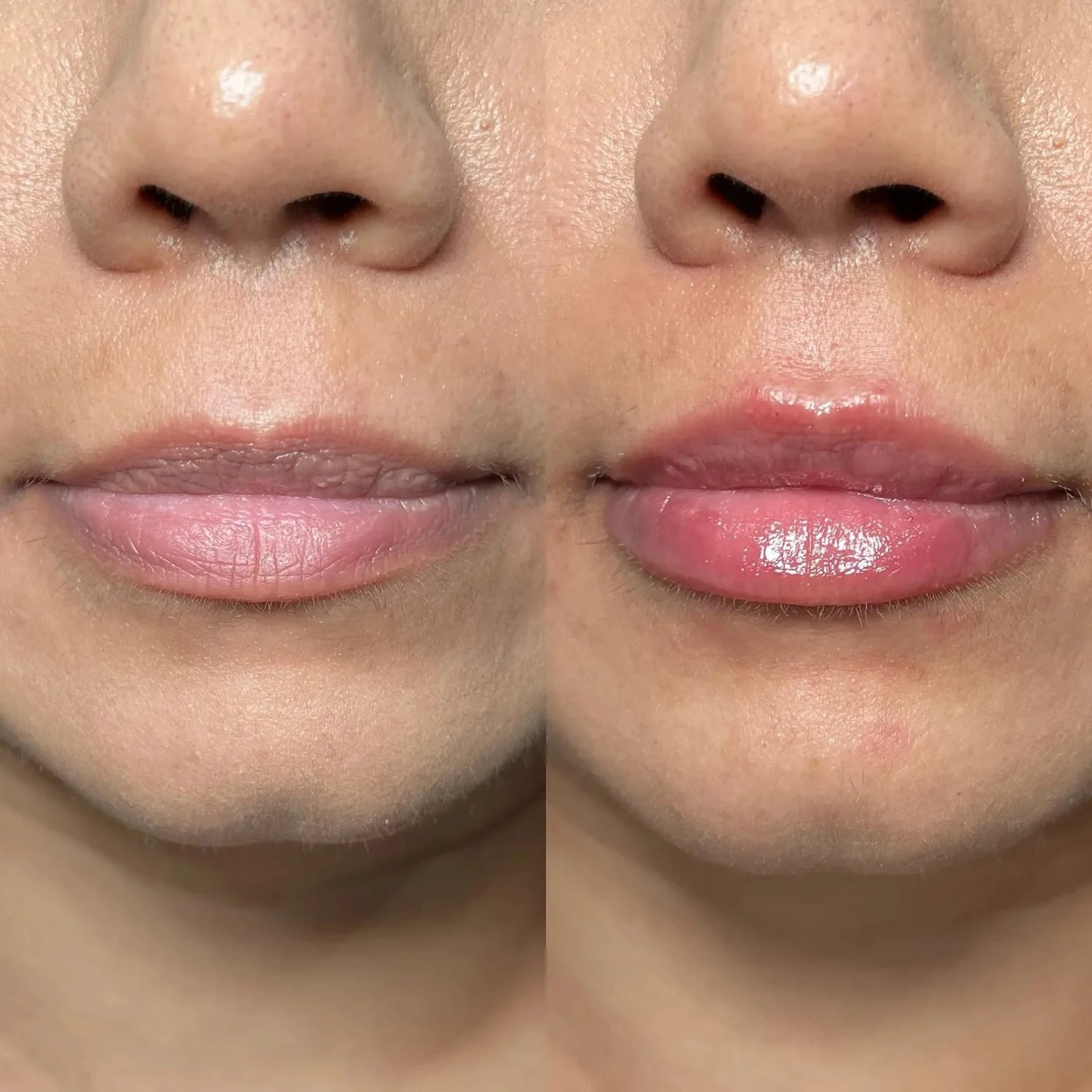 Dermal Fillers Malta: Enhancing Beauty with Venus Distribution Malta