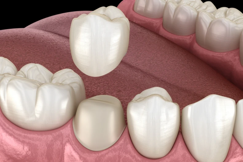 What You Need to Know About Tooth Restoration Treatments