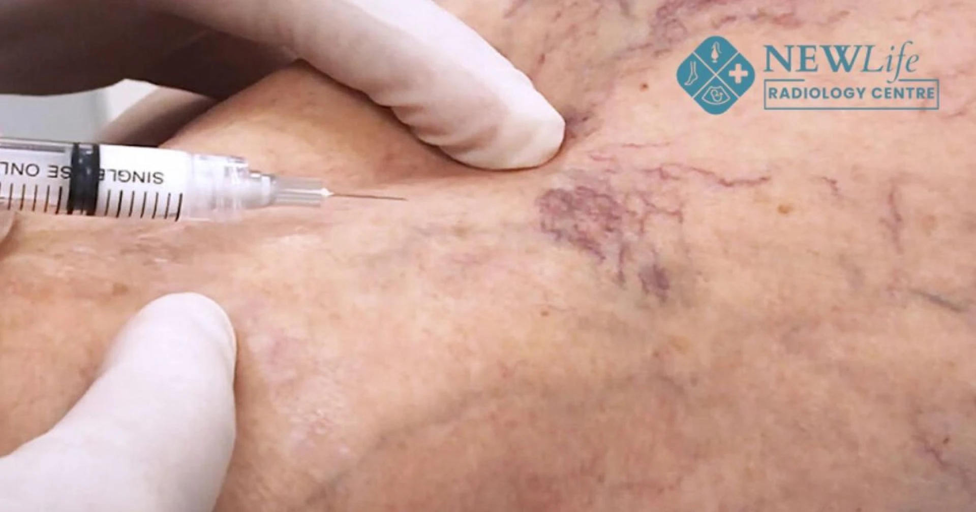 Did You Know Sclerotherapy Treatment in Thane Can Improve Both Health and Appearance?
