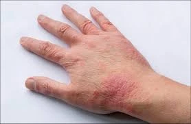 Atopic Dermatitis Market Barriers Highlighting Key Limitations And Strategic Approaches Globally