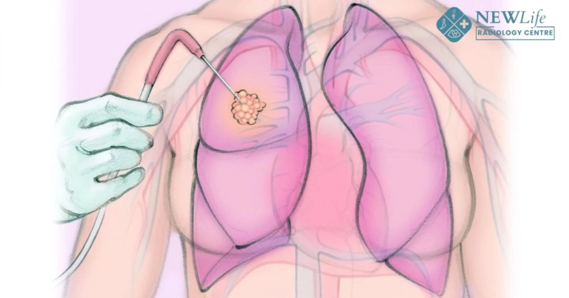 Why Microwave Tumour Ablation Treatment in Thane Is Becoming a Trusted Option for Patients