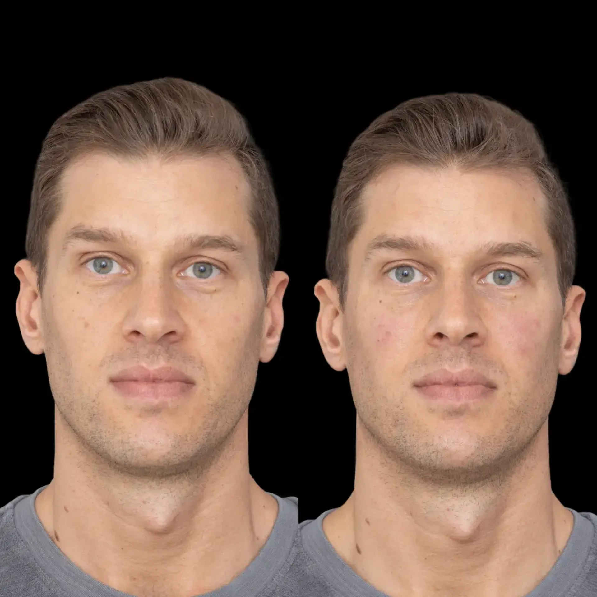 How the Best Aesthetic Clinics in dubai Use Jawline Fillers for a Youthful Look