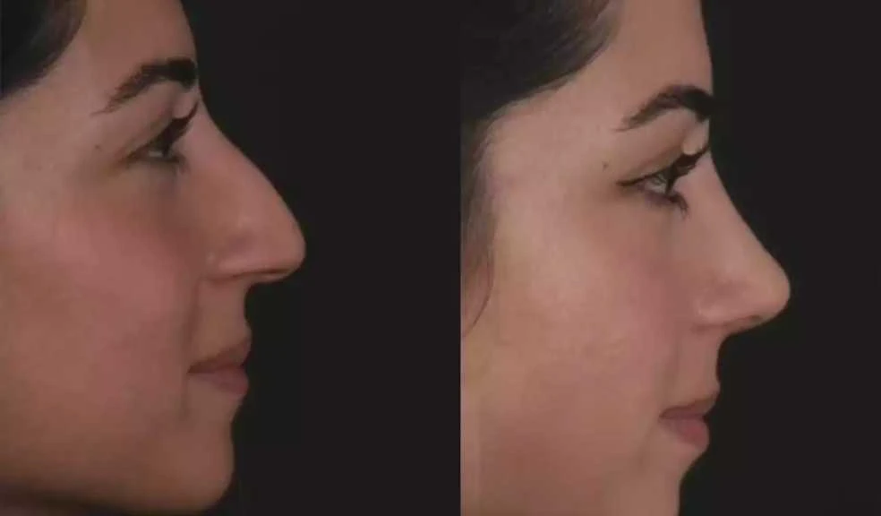 Best Septoplasty Surgeon in Dubai: Questions to Ask in Consultation