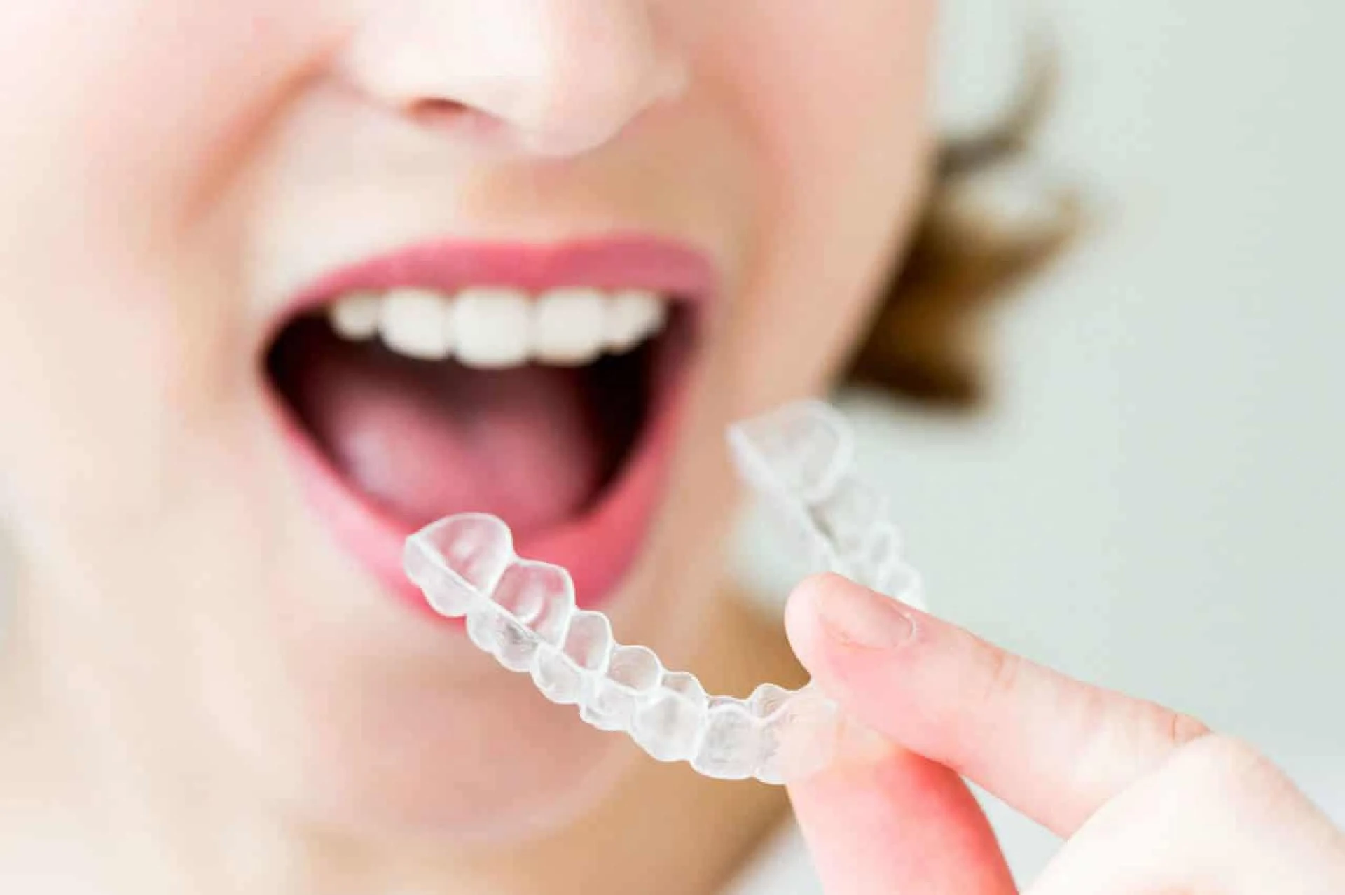Clear Aligners Fayetteville NC: A Modern Way to Straighten Your Smile