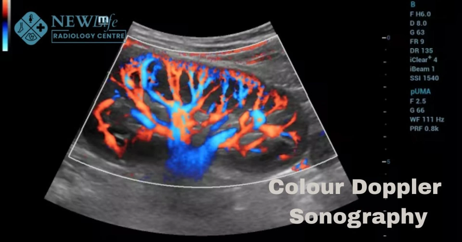 Colour Doppler Sonography in thane Advanced Imaging with Expert Guidance
