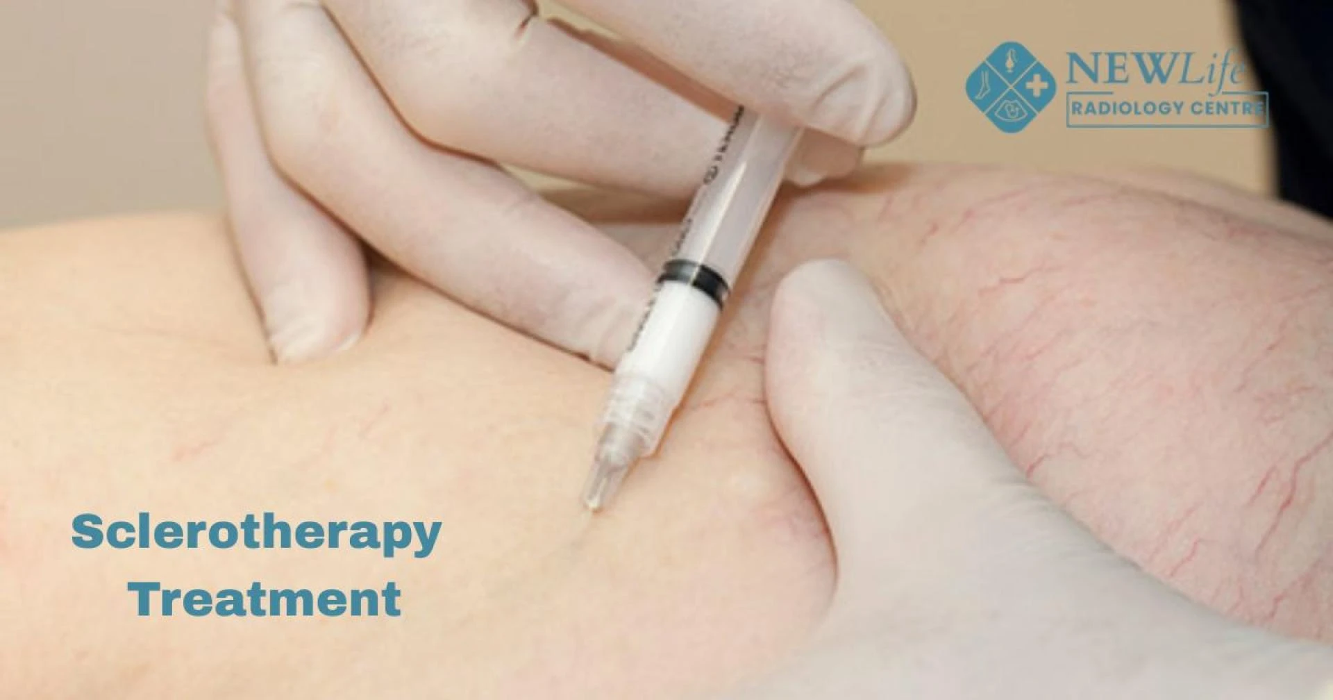 Sclerotherapy Treatment in Thane – Did You Know This Simple Post-Session Tip Speeds Up Recovery?