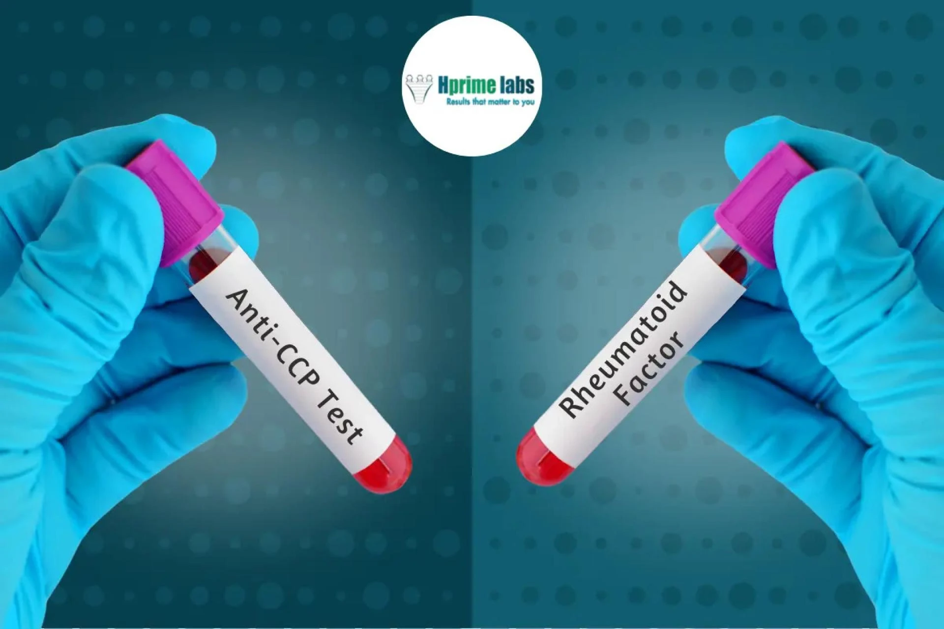 Anti-CCP vs Rheumatoid Factor: Understanding the Key Tests for Rheumatoid Arthritis