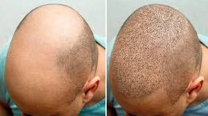 Restore Your Confidence with Hair Transplants in Riyadh