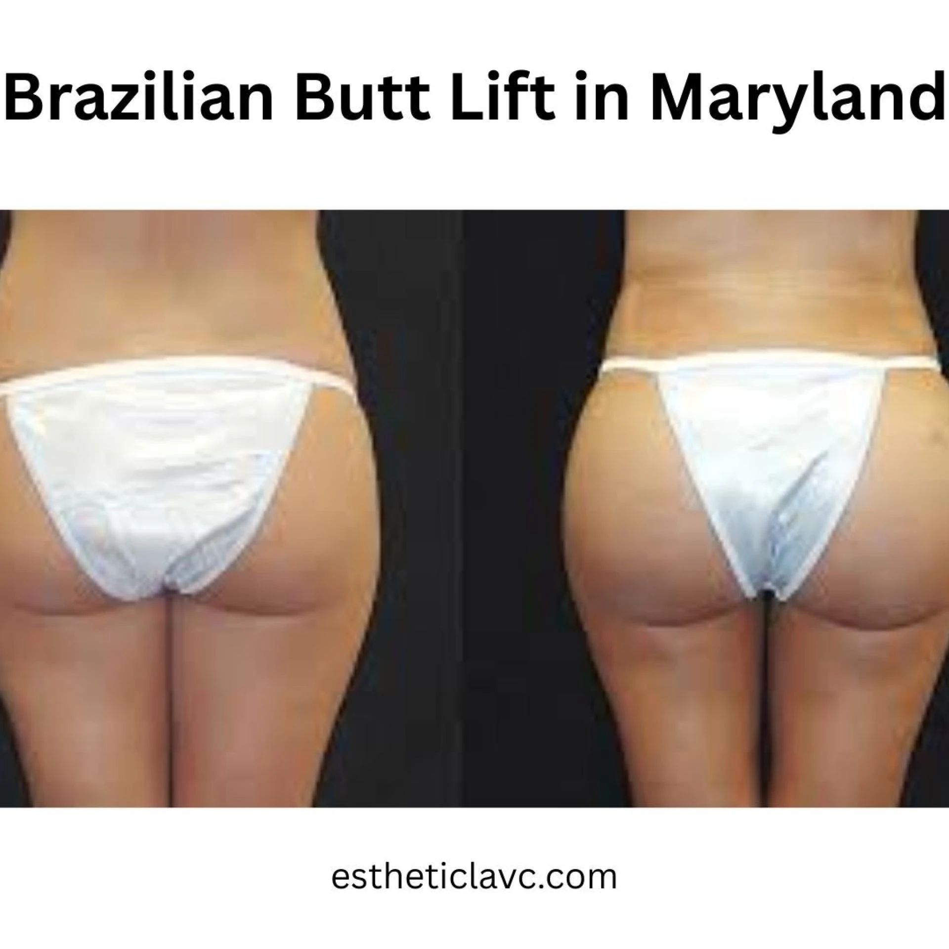 Brazilian Butt Lift in Maryland: What You Need to Know Before Surgery