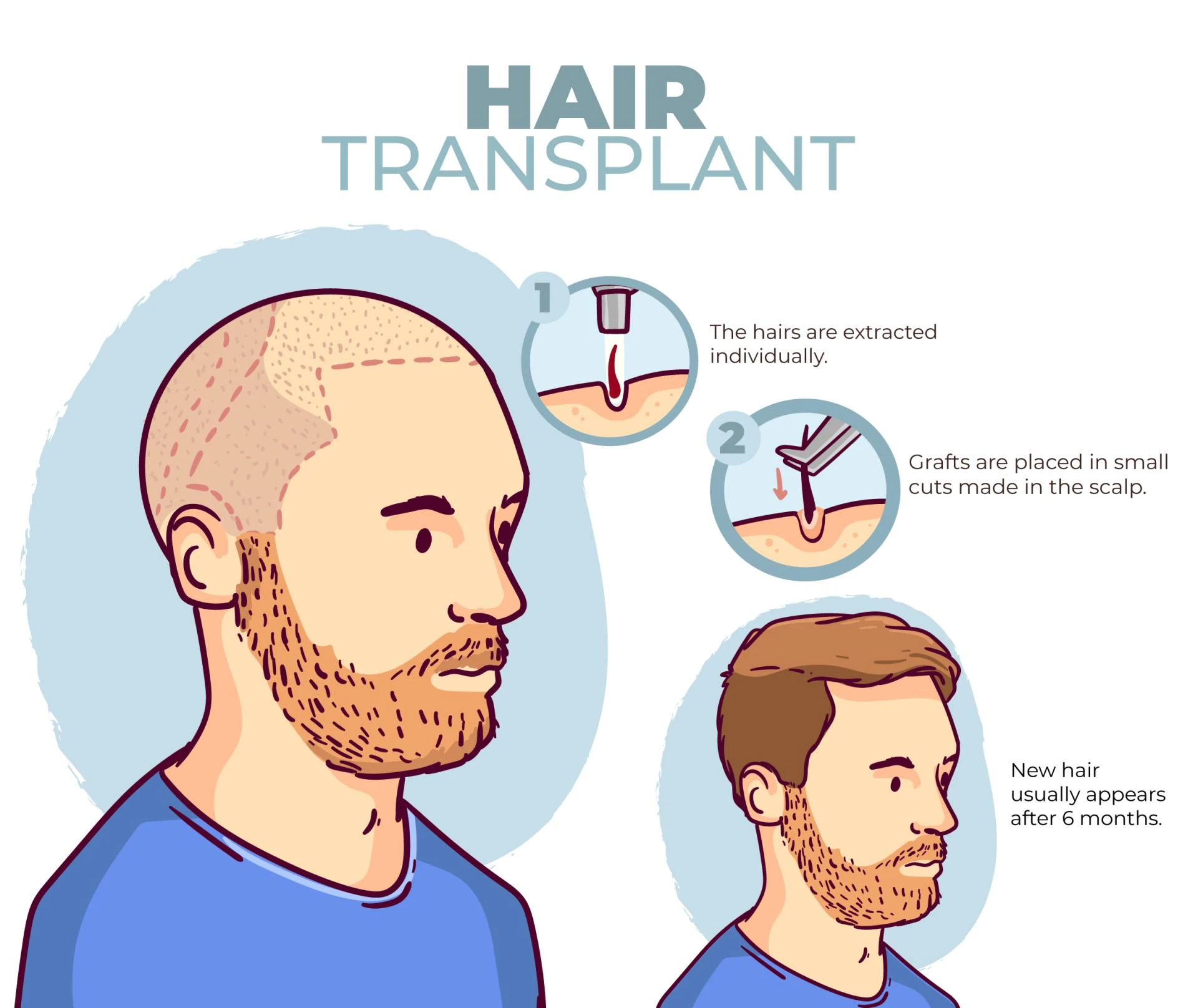 Signs That Determine You Need A Hair Transplant Right Now