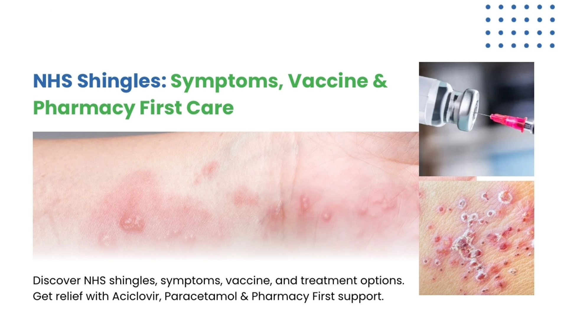 Shingles Explained: NHS Care & Treatment
