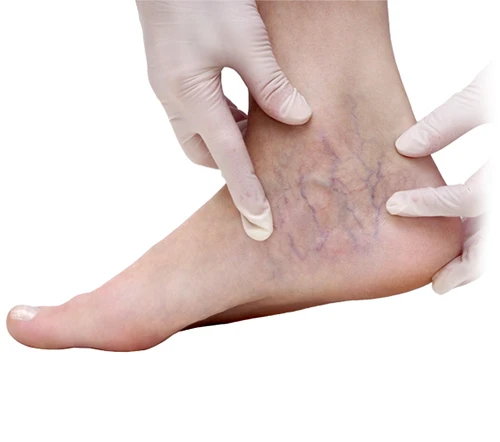 Best Doctor for Varicose Veins in Indore – Advanced Treatment & Expert Care