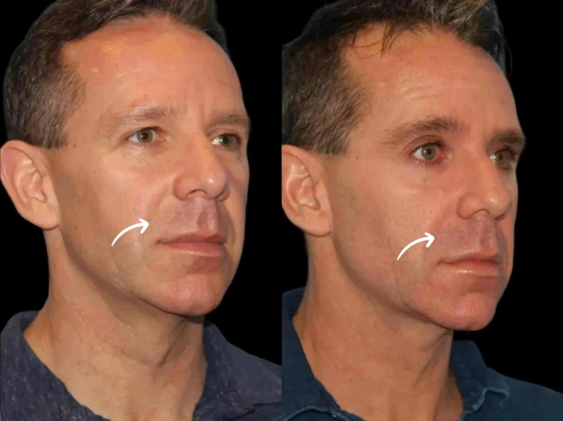 Growth Plans: Sculptra & Best Plastic Surgeon in Dubai