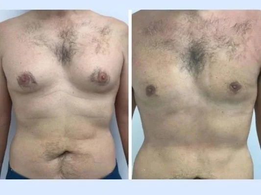 Gynecomastia in Dubai: What Happens If Left Untreated
