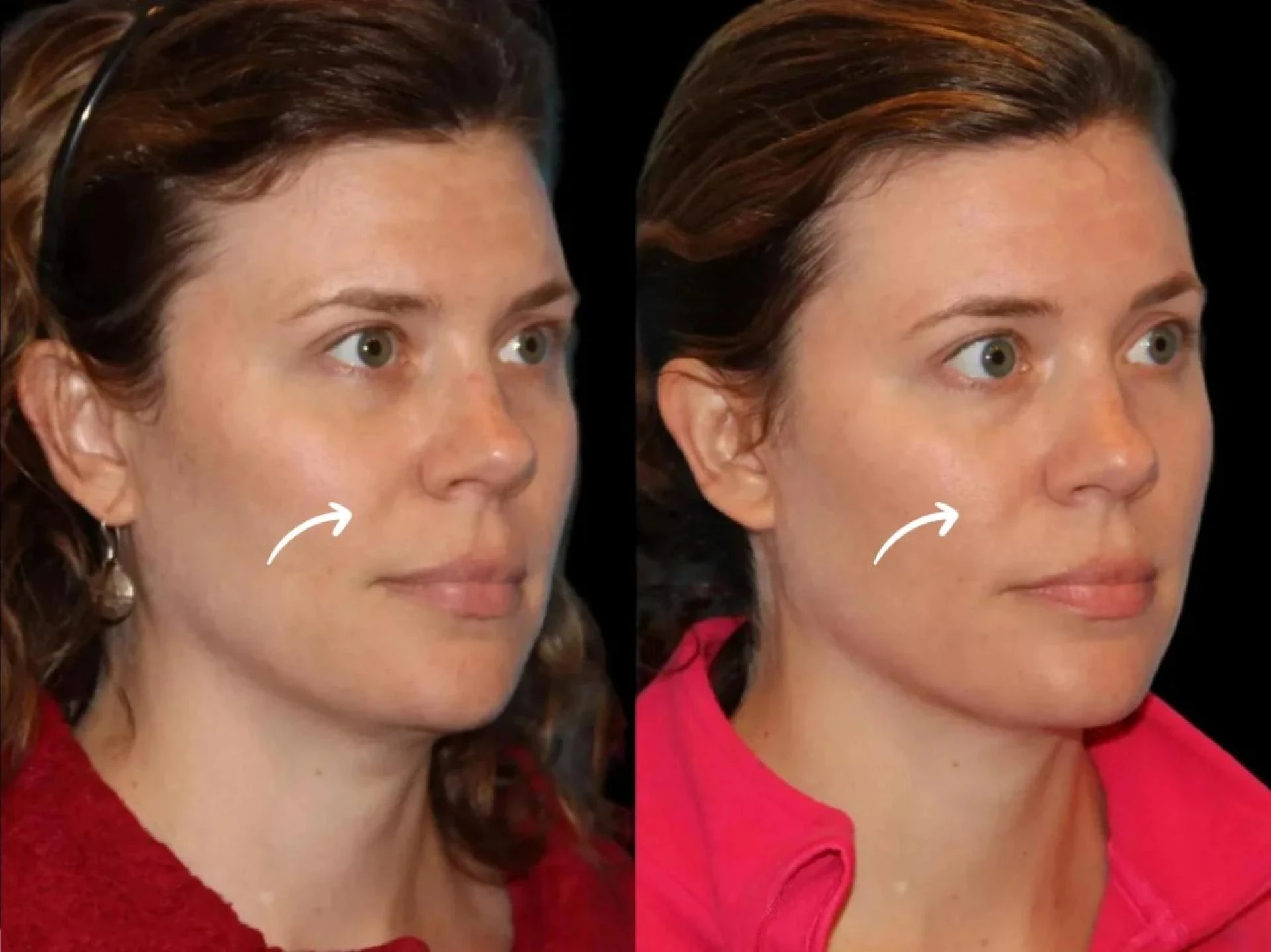 Best Doctors in Dubai promote Sculptra for natural volumizing effect