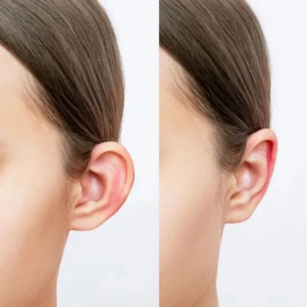 Ear Reshaping Surgery in Islamabad for Perfectly Balanced Earsost Title
