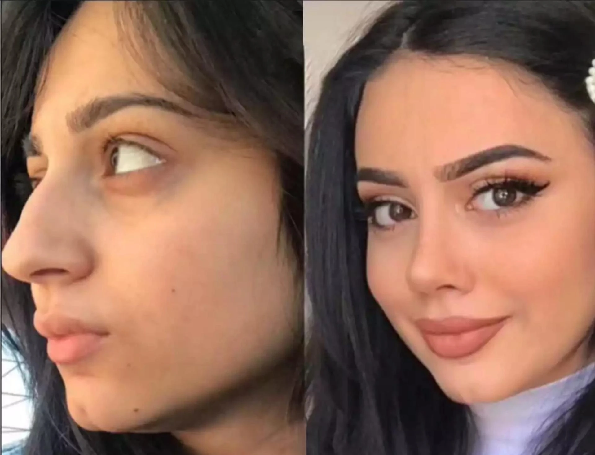 Breathe Freely, Look Beautifully: Best Rhinoplasty Surgeon in Dubai