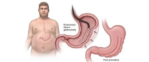 Why Endoscopic Sleeve Gastroplasty Is Becoming Georgia’s Go-To Weight Loss Solution