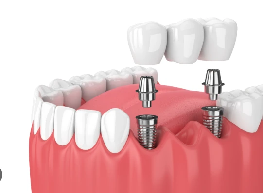 Dental Implants vs. Bridges: Pros, Cons, and Cost