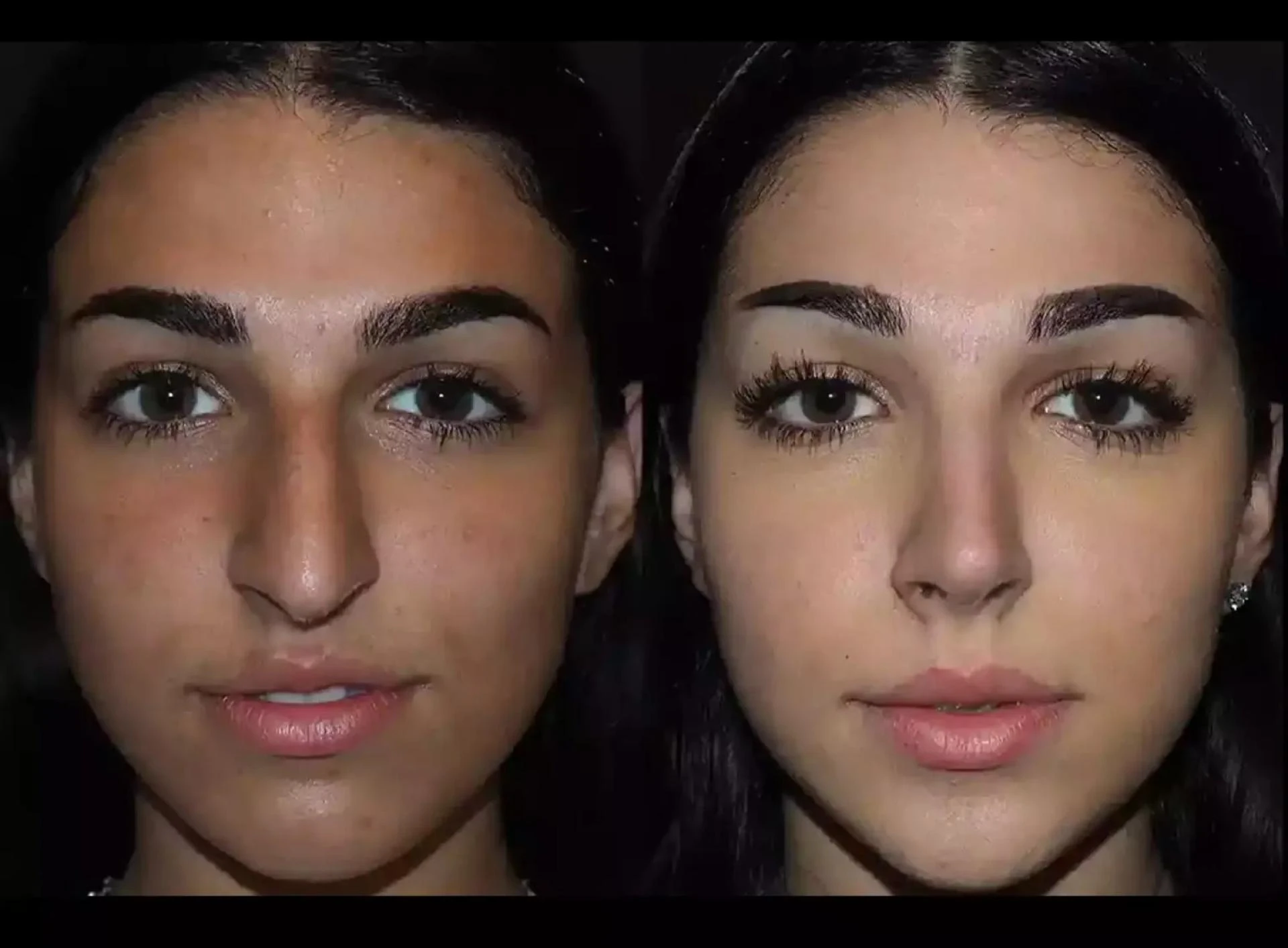 Septoplasty in Dubai: What Patients Should Know Before Choosing Treatment