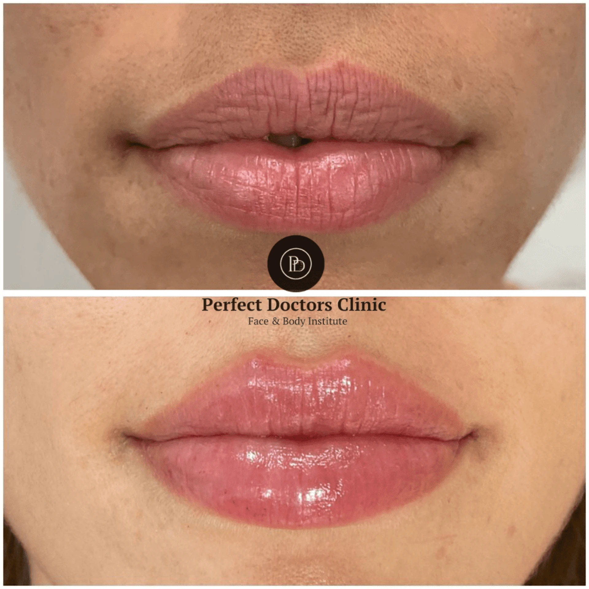Juvederm Before And After Guide: Tips by the Best Doctors in Dubai